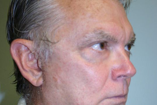 Eyelid Surgery Before & After