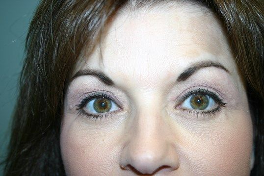 Eyelid Surgery Before & After