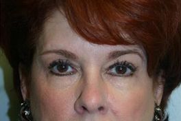 Eyelid Surgery Before & After