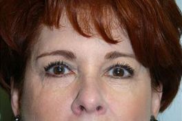 Eyelid Surgery Before & After