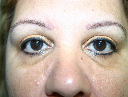 Eyelid Surgery Before & After