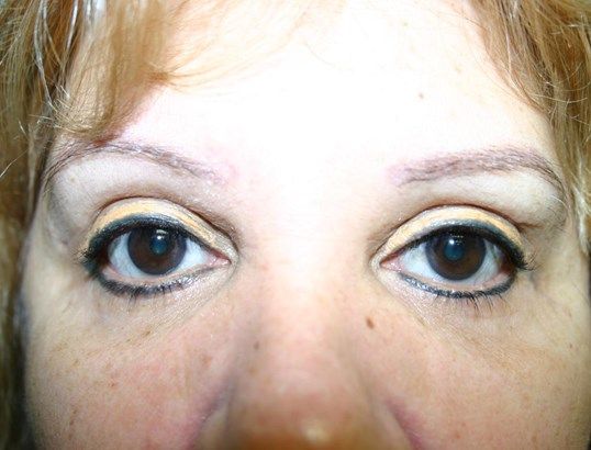 Eyelid Surgery Before & After
