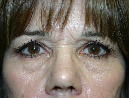 Eyelid Surgery Before & After