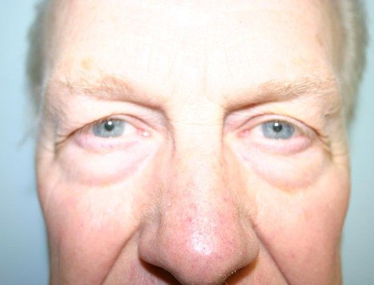 Eyelid Surgery Before & After