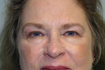 Eyelid Surgery Before & After