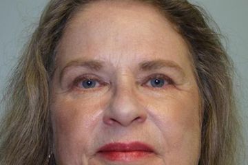 Eyelid Surgery Before & After