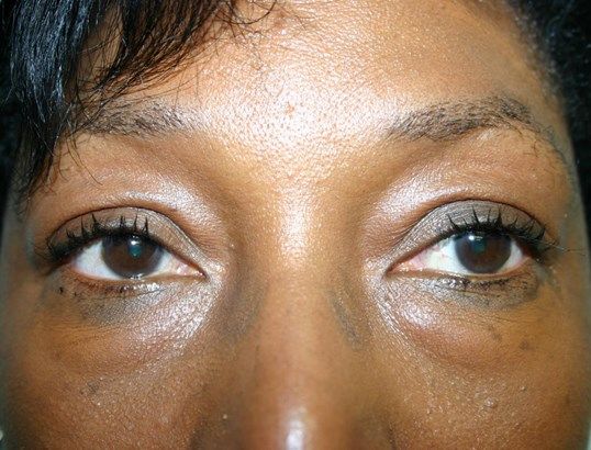 Eyelid Surgery Before & After