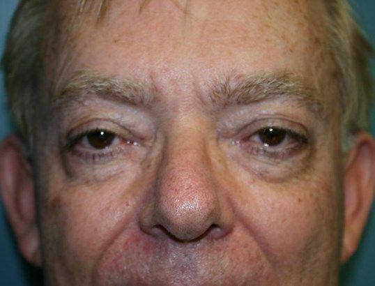 Eyelid Surgery Before & After