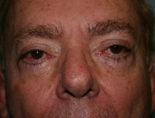 Eyelid Surgery Before & After