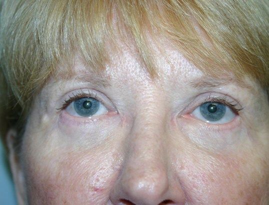 Eyelid Surgery Before & After
