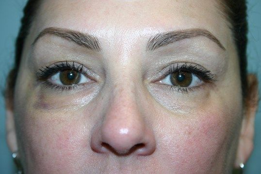 Eyelid Surgery Before & After