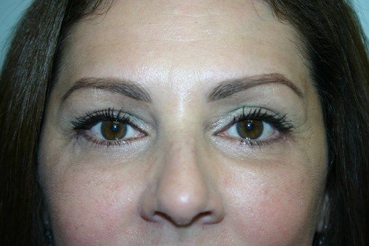 Eyelid Surgery Before & After