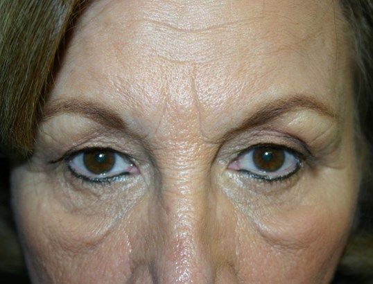 Eyelid Surgery Before & After