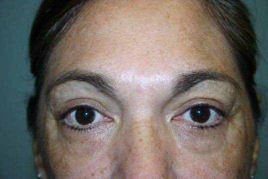 Eyelid Surgery Before & After