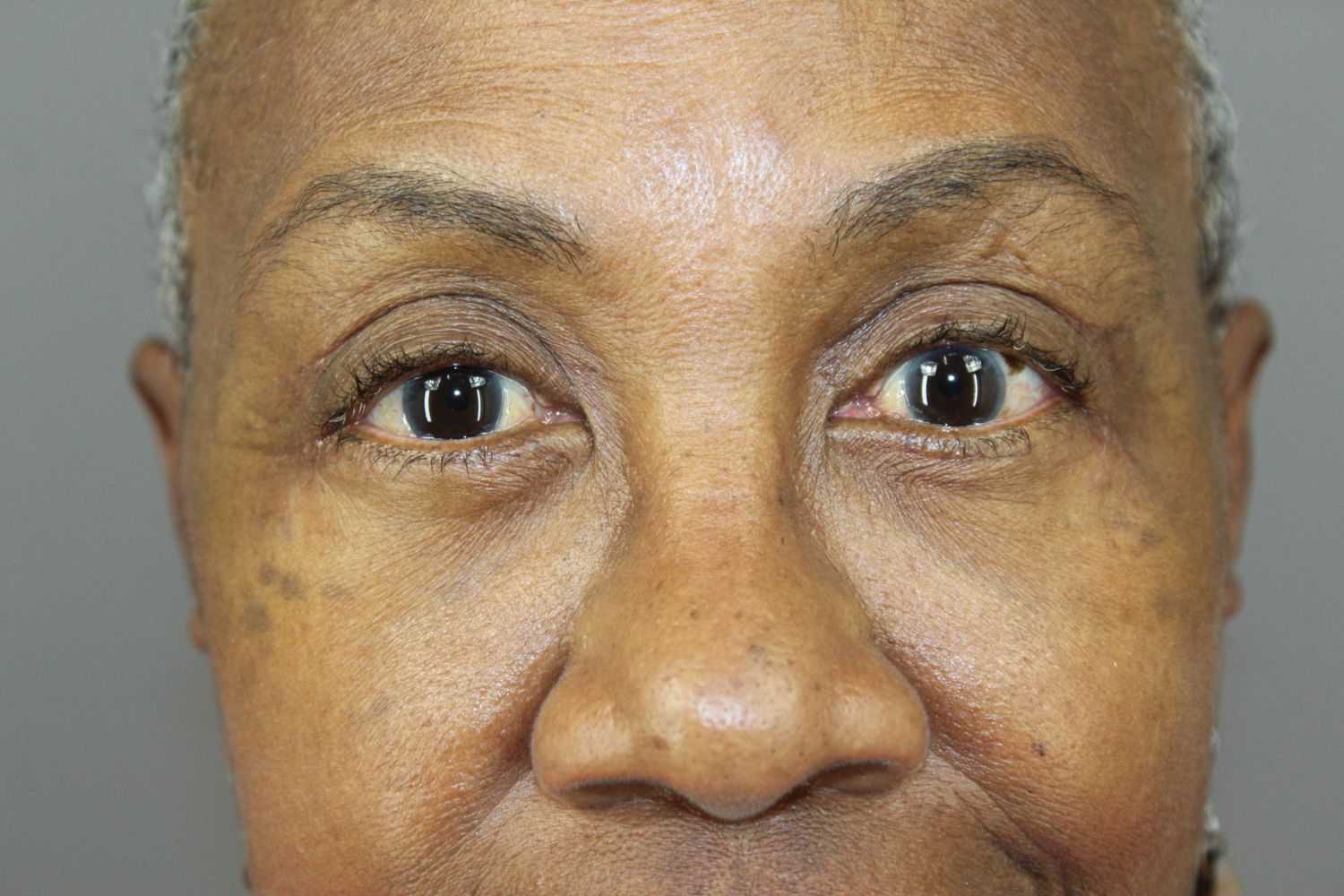 Eyelid Surgery Before & After