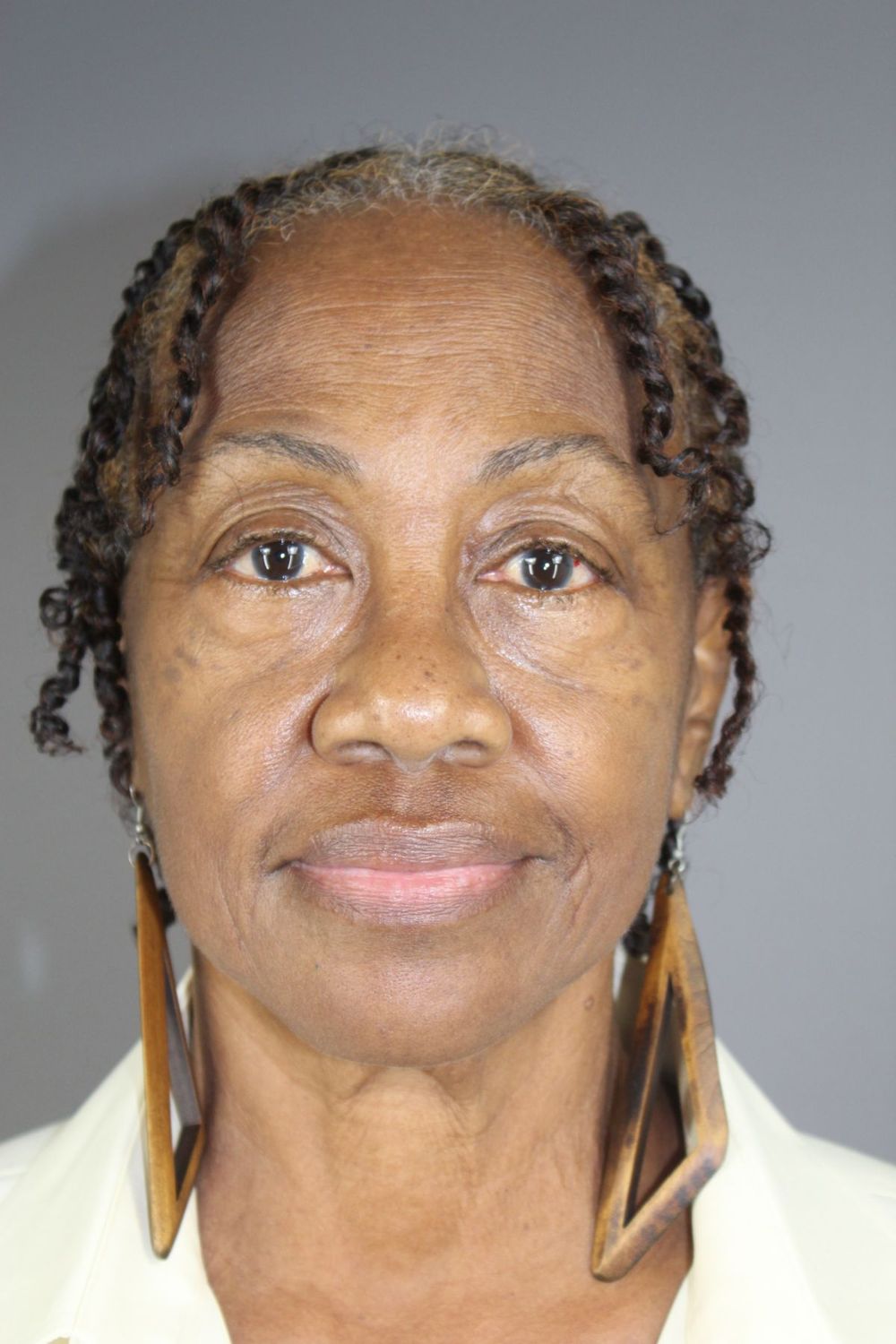 Eyelid Surgery Before & After