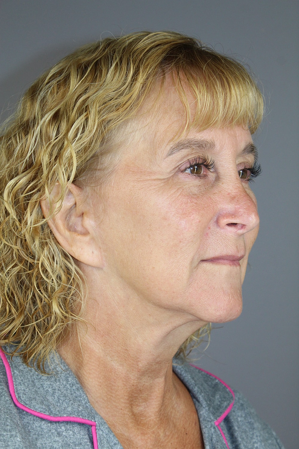 Eyelid Surgery Before & After