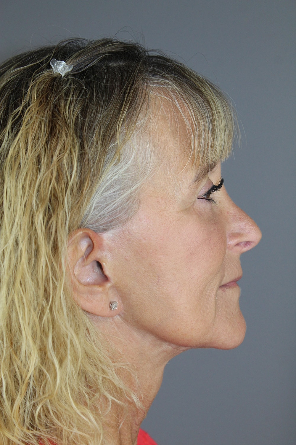 Eyelid Surgery Before & After