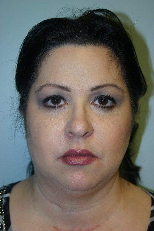 Kybella Before & After