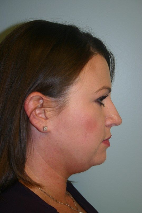 Kybella Before & After