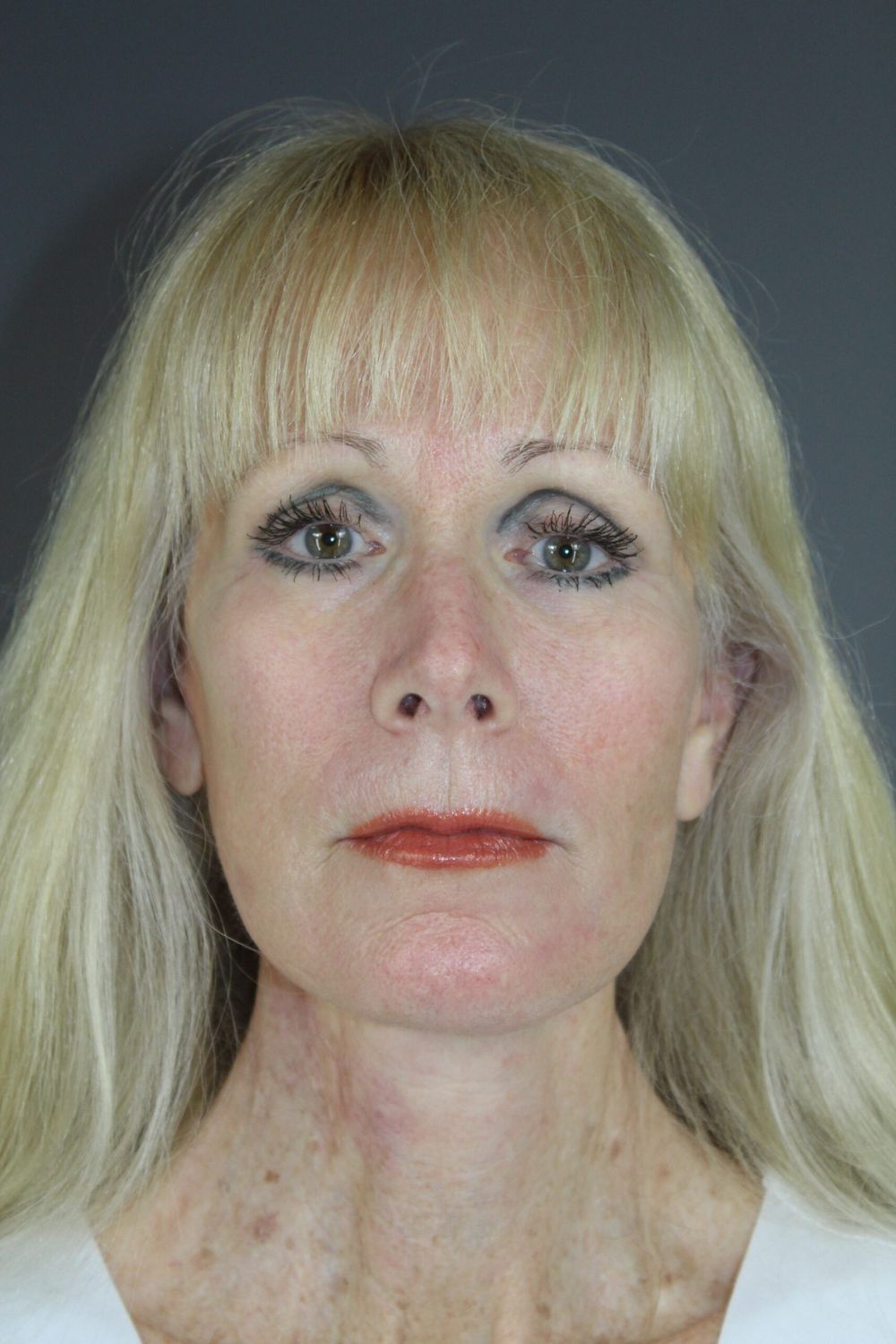 Brow Lift Before & After