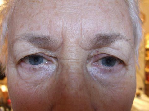 Brow Lift Before & After