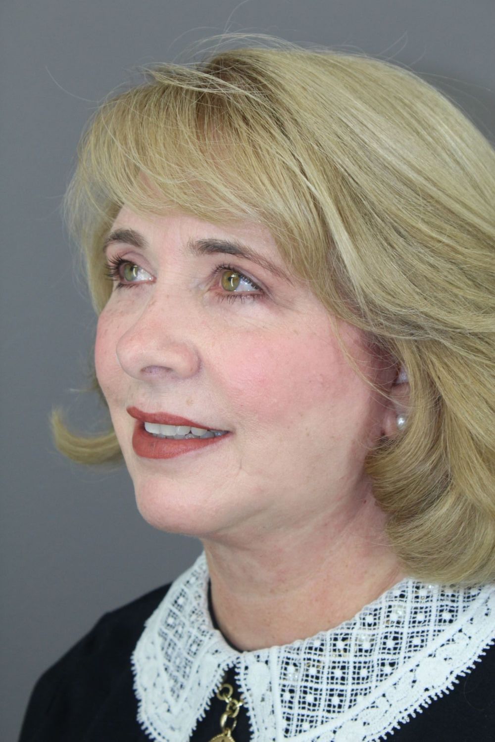 Zo Skin Health Before & After