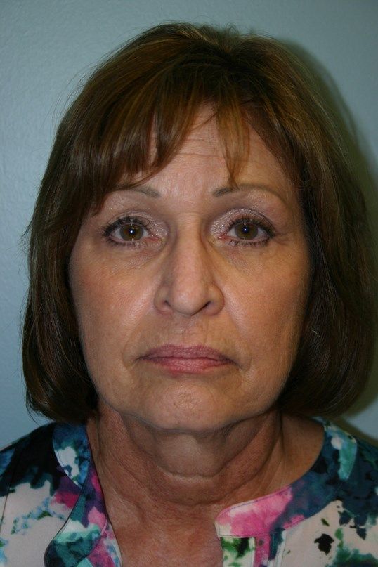 Zo Skin Health Before & After