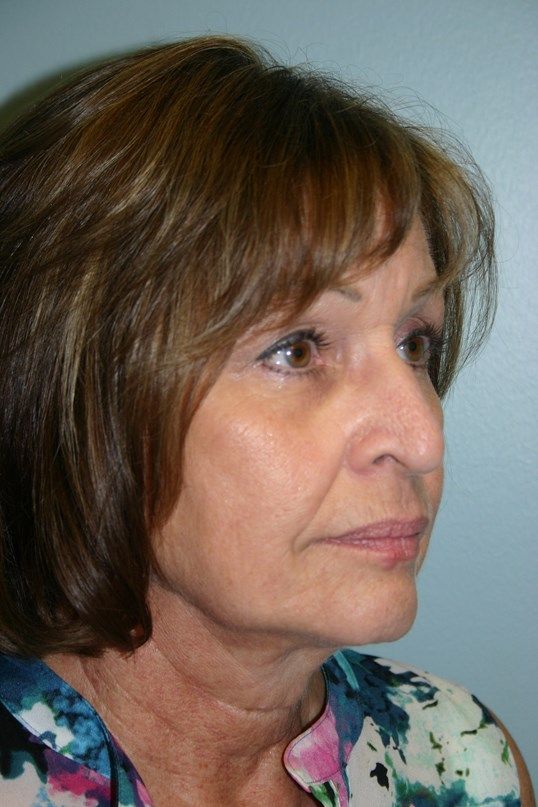 Zo Skin Health Before & After