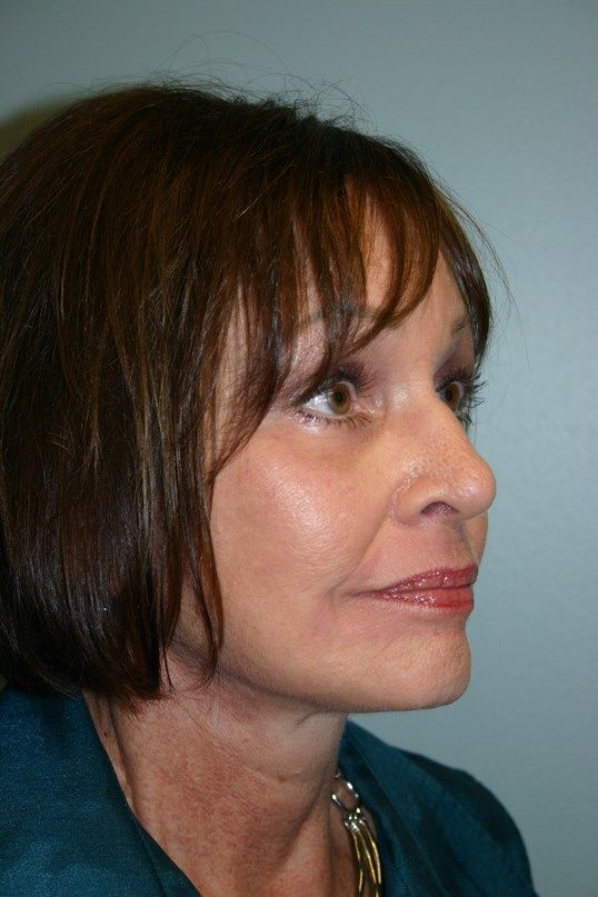 Zo Skin Health Before & After