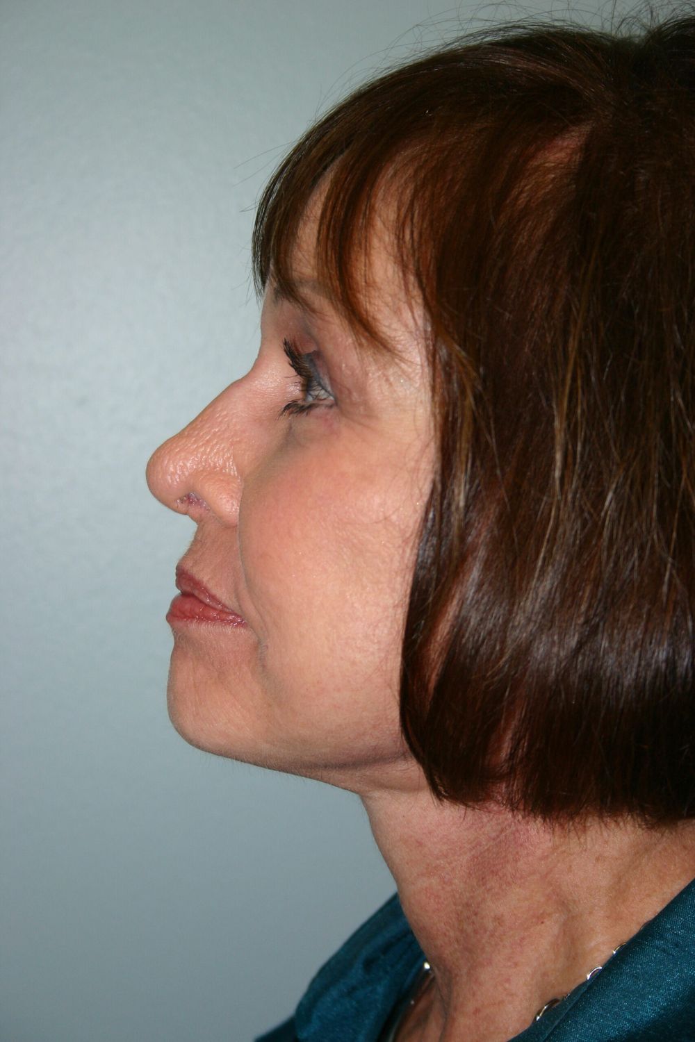 Zo Skin Health Before & After