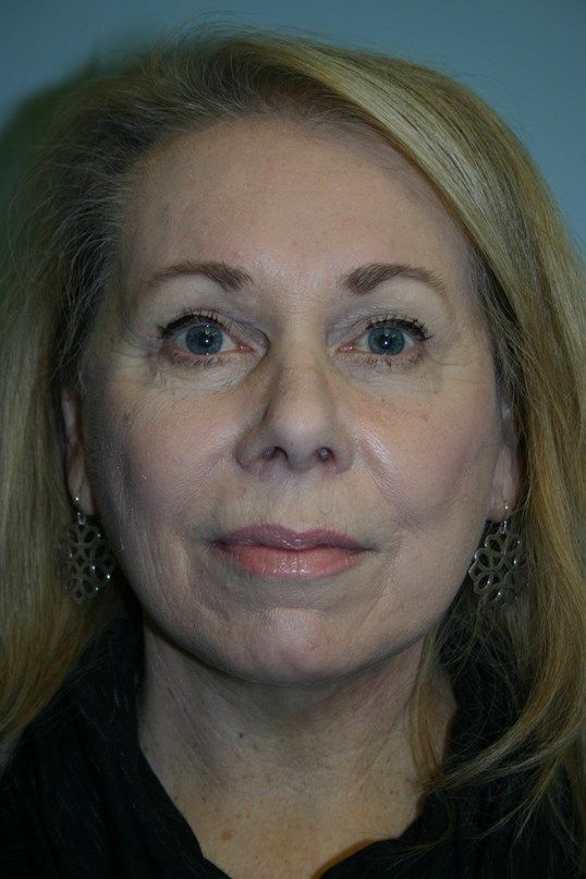 Zo Skin Health Before & After