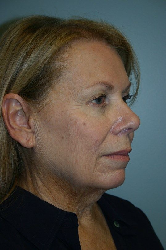 Zo Skin Health Before & After