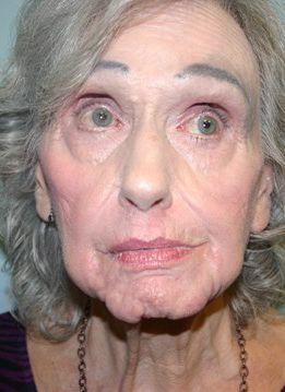 Zo Skin Health Before & After