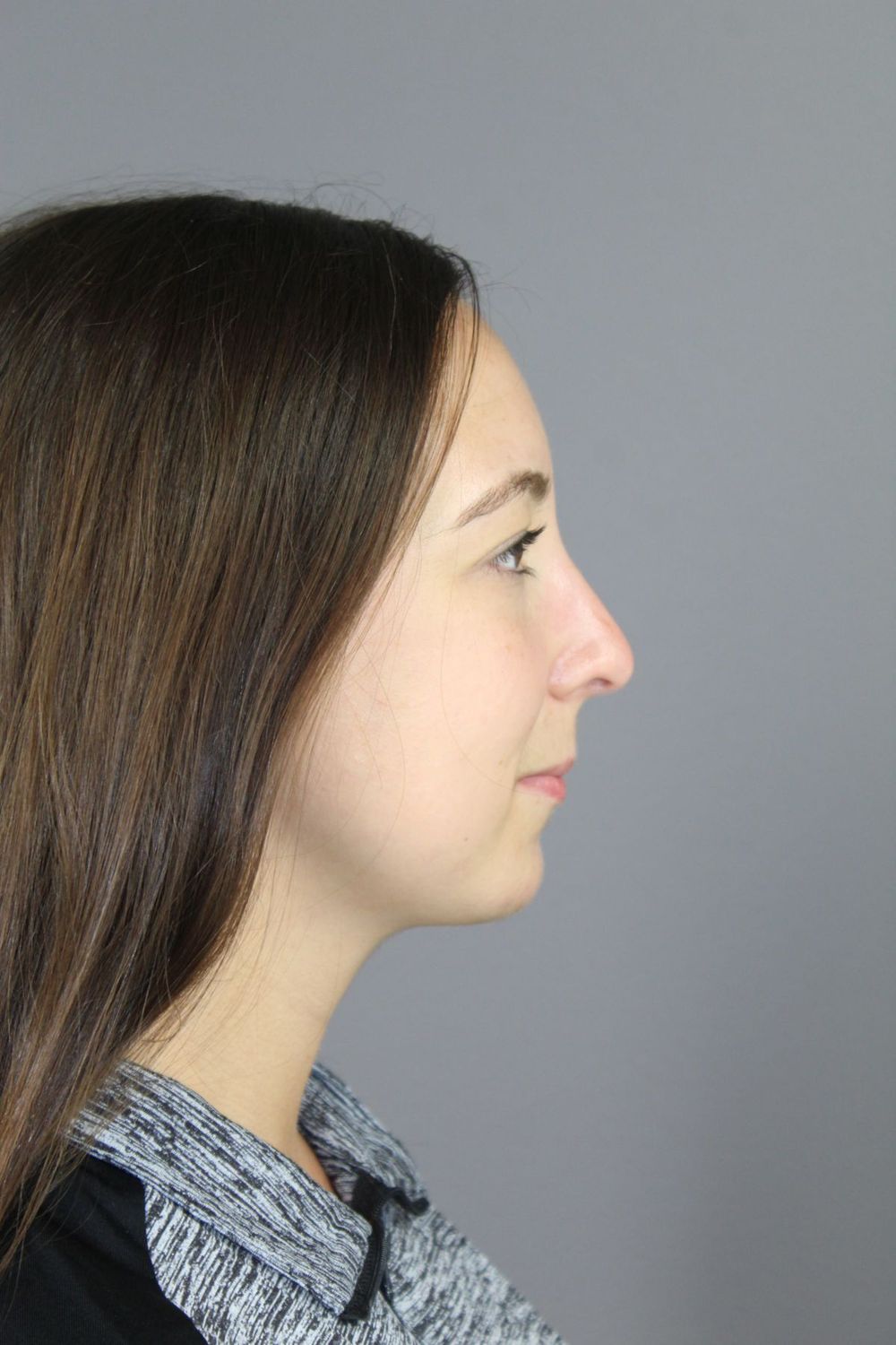 Chin Augmentation Before & After
