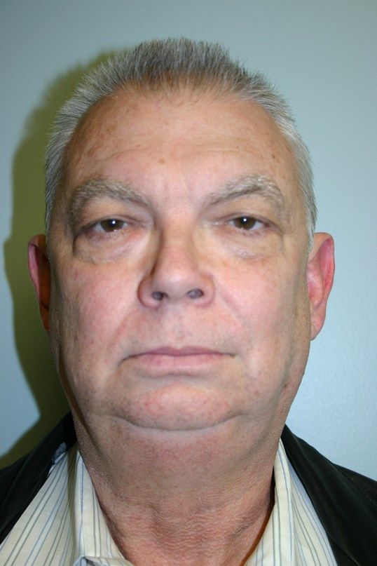 Chin Augmentation Before & After