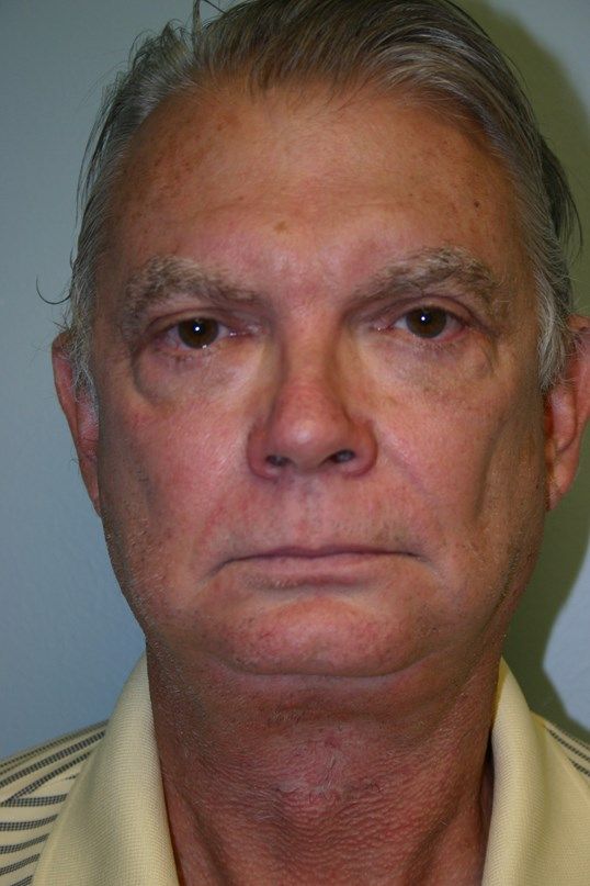 Chin Augmentation Before & After