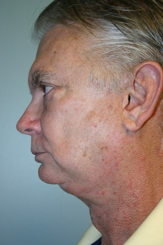 Chin Augmentation Before & After