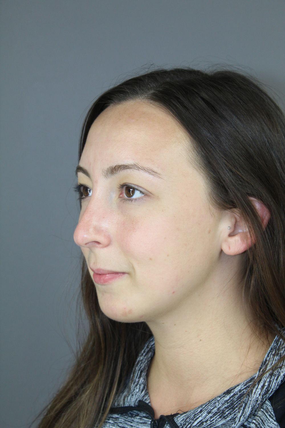 Chin Augmentation Before & After