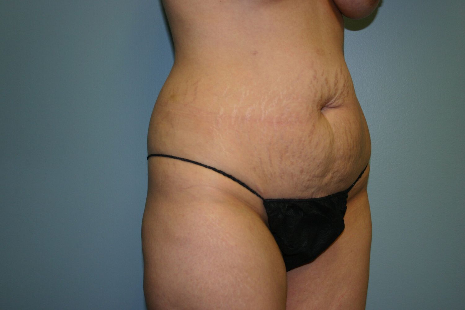 Fat Transfer Before & After