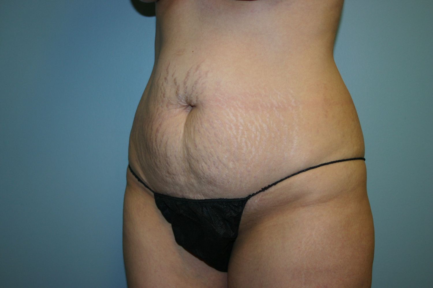 Fat Transfer Before & After