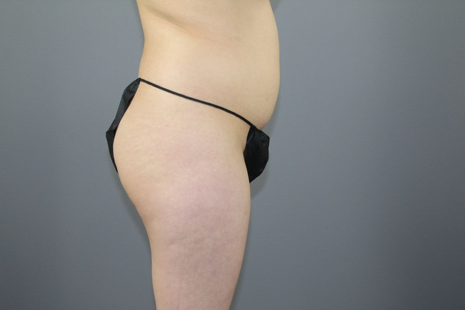 Fat Transfer Before & After