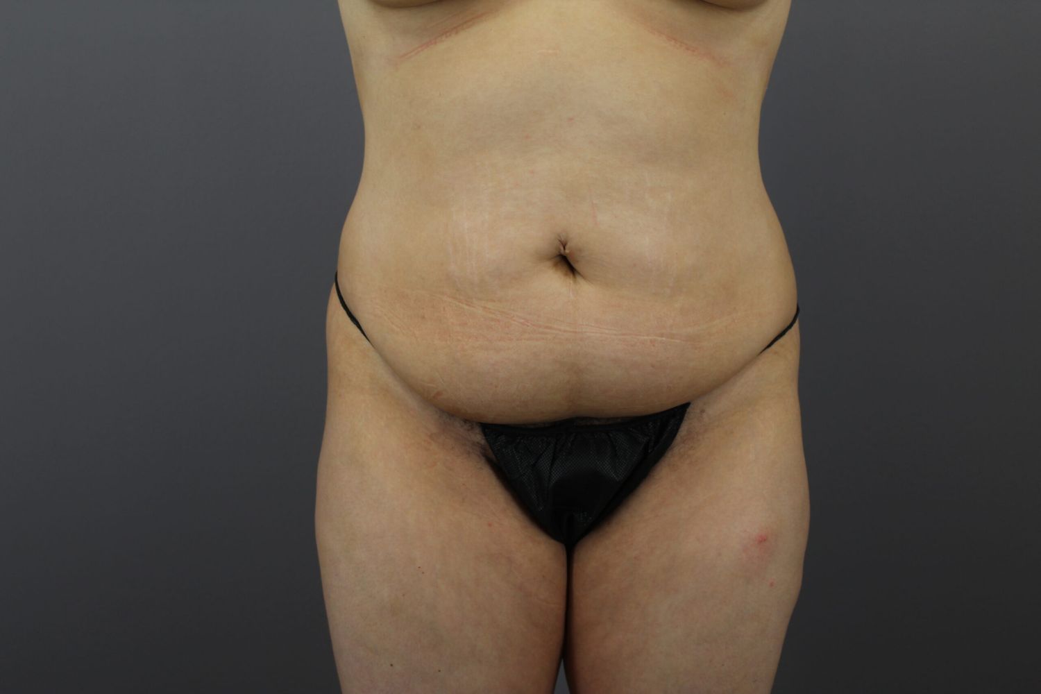 Fat Transfer Before & After