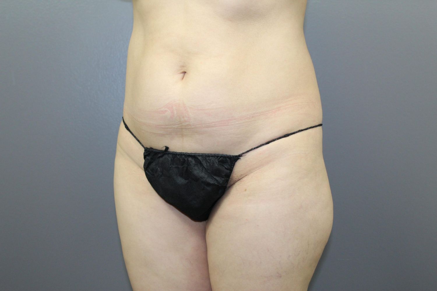 Fat Transfer Before & After