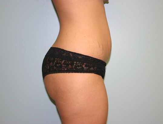 Fat Transfer Before & After