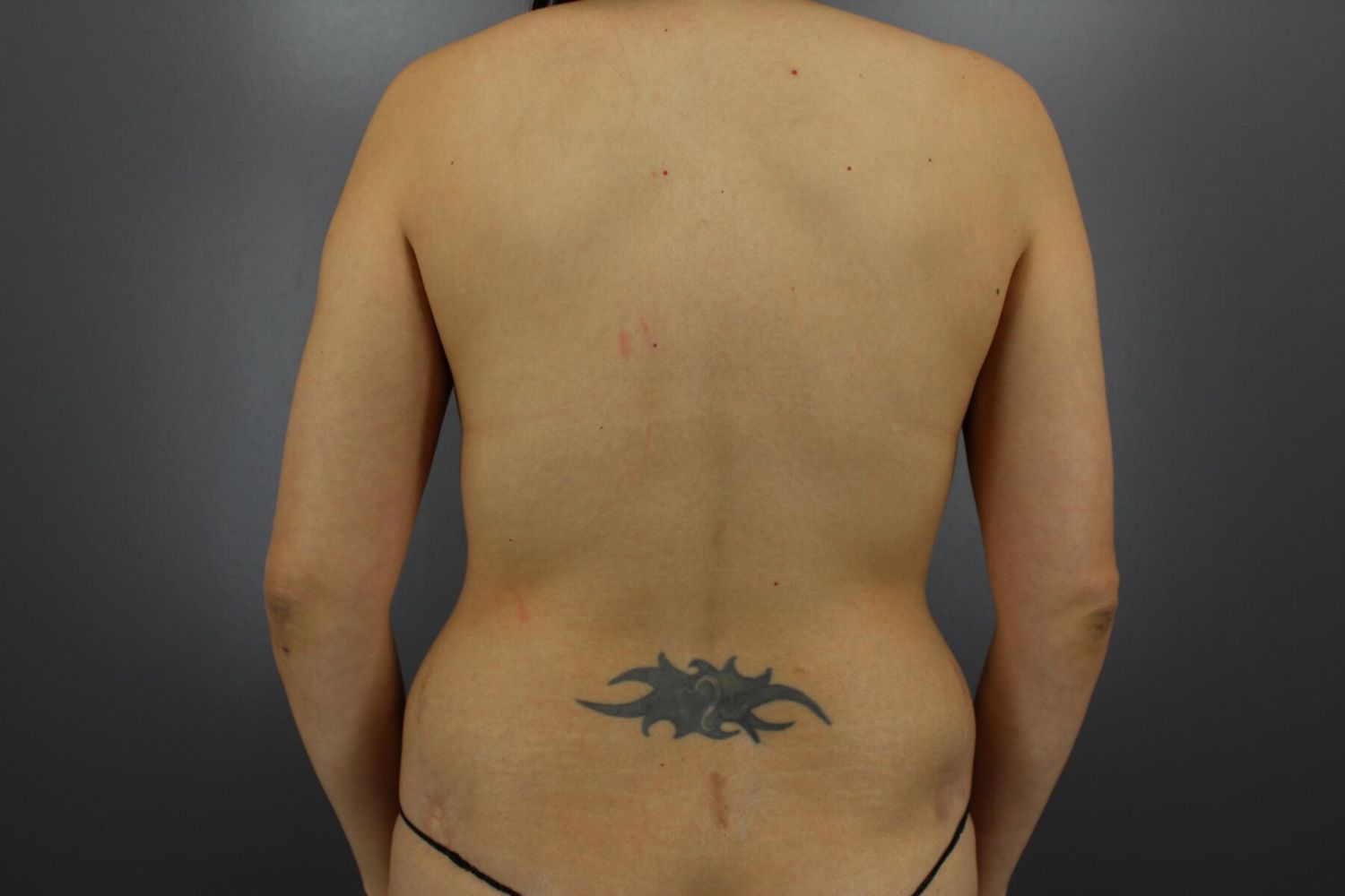 Fat Transfer Before & After