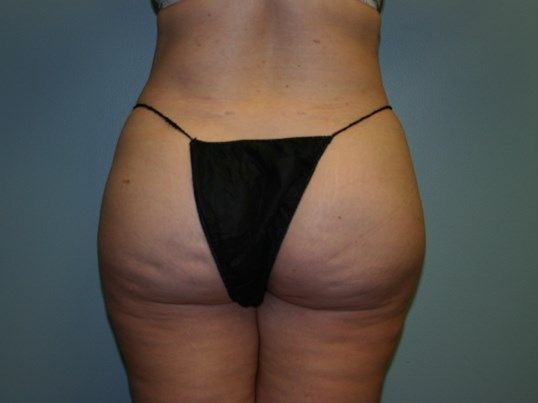 Fat Transfer Before & After