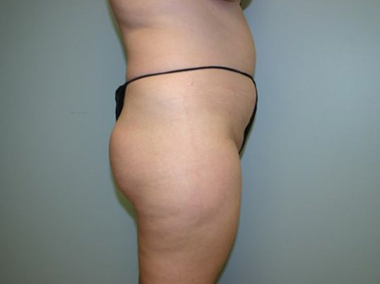 Fat Transfer Before & After