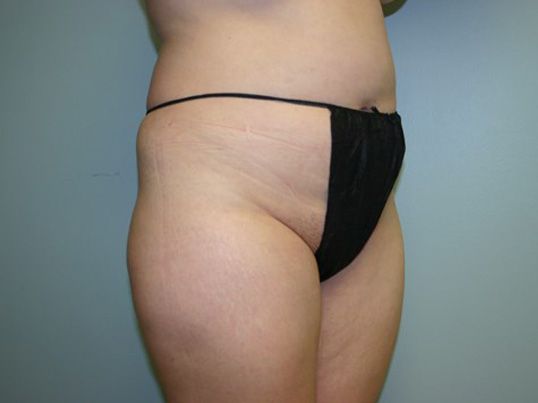 Fat Transfer Before & After