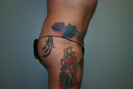 Fat Transfer Before & After